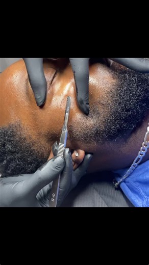 Dermaplaning Facials for Glowing Skin in Little Rock