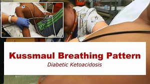 Kussmaul Breathing Pattern