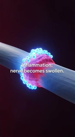 Two Types of Nerve Pain… Only One Shows on Scans