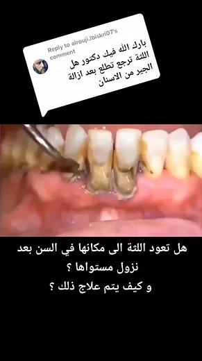 Treatment for Receding Gums and Gum Recession in Dentistry