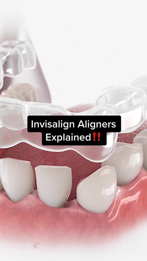 How Does Invisalign Aligners Straighten Teeth #animation #teeth #orthodontist #invisalign
