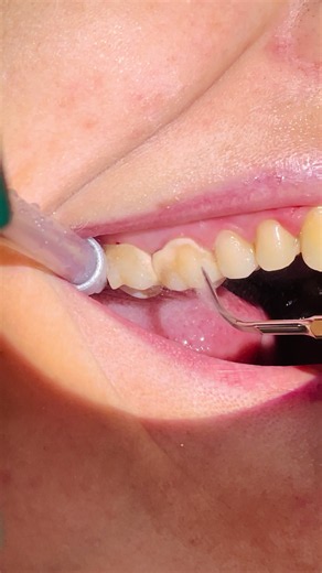 Some Satisfying ASMR Dental Cleaning #asmr #satisfying #dentist #dentistry #dental