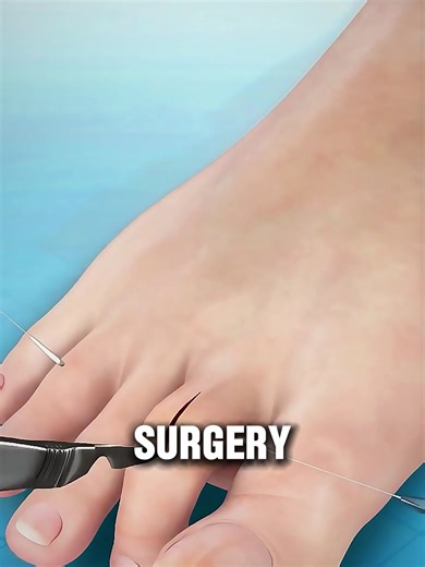 Hammer Toe Surgery 😳 | How Doctors Straighten a Bent Toe! #hammertoe #hammertoesurgery #footsurgery #podiatry #medicalanimation