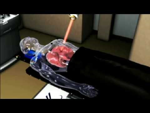 CyberKnife: Treatment of Lung Cancer