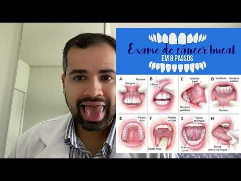 CÂNCER DE BOCA: sinais, sintomas, prevenção e tratamento. Saiba tudo nesse vídeo! #câncer #boca