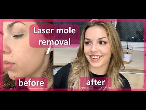 Laser mole removal at a Korean skin care clinic.