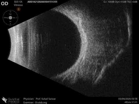 20 MHz Annular Ophthalmic Ultrasound ABSolu, Pseudotumor orbit , 37052