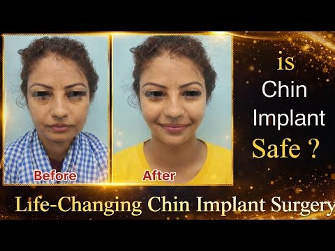 Chin Implant Surgery In Mumbai | Cost Of Chin Implant Surgery In Mumbai Zenith Clinic