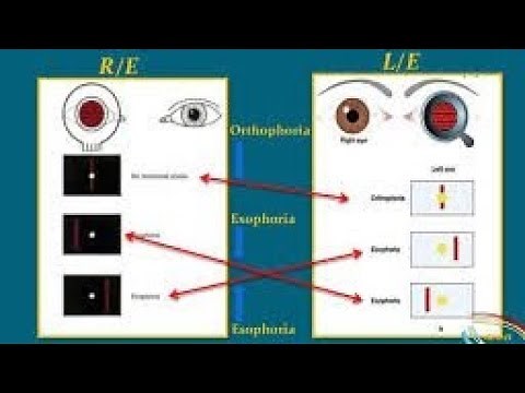Maddox Rod Test || How to measure phoria|| ft. Krishna kumar gupta|| Optometry goals