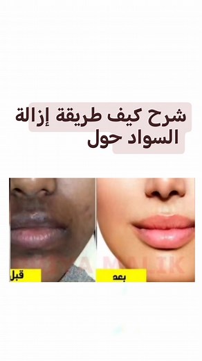 طريقة إزالة السواد حول الفم بإستخدام البطاطس