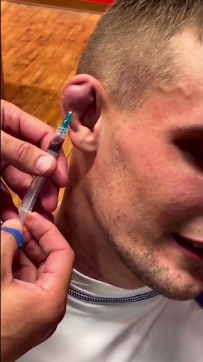 Cauliflower ear draining Pt. 2 👂🏼 💉