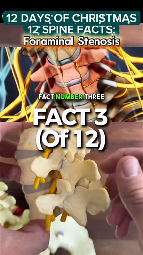 𝘾𝙝𝙚𝙨𝙩𝙚𝙧 𝙅 𝘿𝙤𝙣𝙣𝙖𝙡𝙡𝙮 𝙄𝙄𝙄, 𝙈𝘿 on Instagram: "🔍𝘾𝙝𝙚𝙘𝙠 𝙮𝙤𝙪𝙧 𝙈𝙍𝙄 𝙧𝙚𝙥𝙤𝙧𝙩 — does it say 𝙛𝙤𝙧𝙖𝙢𝙞𝙣𝙖𝙡 𝙨𝙩𝙚𝙣𝙤𝙨𝙞𝙨? Let’s talk about what that actually means.📝 Foraminal stenosis happens when the opening for a nerve becomes too tight, which can lead to leg or arm pain, numbness, or weakness. In this video, I break it down in simple terms, explain why it develops over time, and how we approach treatment — from conservative care to surgery when necessary. �