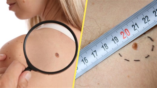 How a simple skin check at home could benefit your health