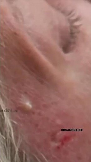 POPPING ‘Seattle Tacoma‘s’ 💥#drpimplepopper #steatocystoma #shorts