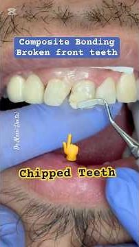 Chipped Teeth Composite Bonding or Dental Veneers