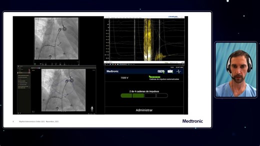 Want to see how single-shot PFA can bring signal guided electrophysiology into your PVI and CTI workflows? 💡 The latest episode of PFA Conversations: Bite-Sized Insights is now available. 📺 Watch now 👉 https://www.arrhythmiaacademy.com/video-index/pfa-conversations-bite-sized-insights?ep=52628&ch=52629&utm_source=facebook&utm_medium=organic_social&utm_campaign=DELV-27536&utm_content=DELV-31319 In Episode 2, Prof Reza Wakili and Dr David Calvo discuss practical strategies for optimising PFA wo