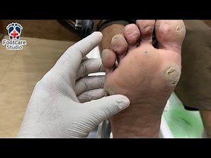 🔴 Live Foot Corn Removal | Real-Time Multiple Corns Extraction