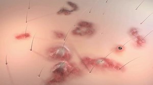 inflammatory acne occurs when bacteria infect clogged or closed pores