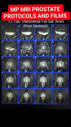 🧲MP MRI PROSTATE FILMS #radiographer #radiography #MRI #mriscan #radtech #Radiology #radiologylife #radiologist #radiologia #mritech #mritechnologist #medicaltechnology #medicaltechnologist #MedicalTech #Xray #CTscan #radtechstudent #radtechlife @top fans | Maruf Bhuiyan The Radiographer