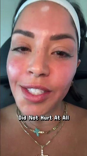 Sculptra + Microneedling + Undereye Stem Cell Injections