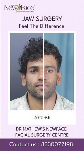 Jaw Surgery Before & After | Facial Balance Transformation | Dr Mathew PC