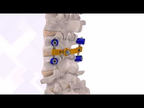 VTI: InterLink™ Pedicle Screw Surgical Technique