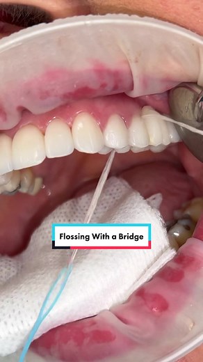 Effective Techniques for Flossing With a Bridge