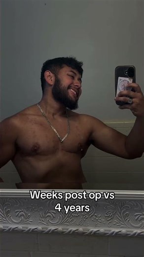 Top surgery saved my life #topsurgery #ftm #lgbt #lgbtcommunity