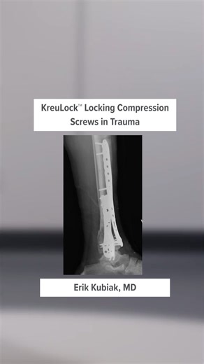 Arthrex Trauma on Instagram: "In today’s #WhatsNewAtArthrex, Erik Kubiak, MD, provides case examples of the application of KreuLock™ locking compression screws. Learn more at the link in our bio. #Orthopedics #MedicalDevices #MedicalEducation #Trauma"