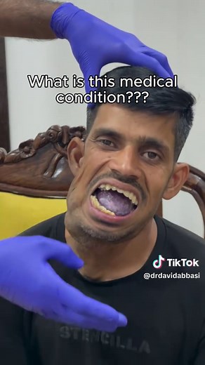 Understanding Hemangioma: What a Purple Tongue Means