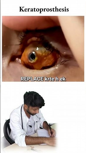 Keratoprosthesis