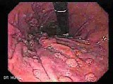 Hyperplastic Gastric Polyposis - Endoscopy (2 of 6) • Video • MEDtube.net