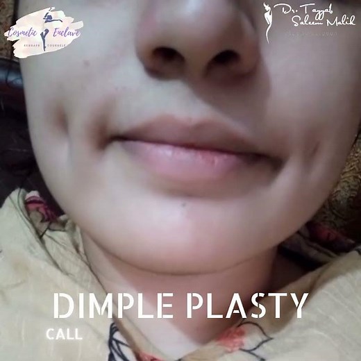 Dimple Surgery. Dimpleplasty