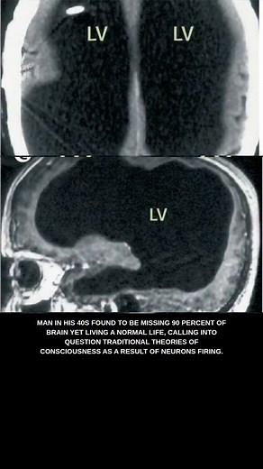 QUANTUM CONSCIOUSNESS A man in France in his 40s went to the hospital to assess pain he was having in his leg. Upon imaging he found to be missing 90 percent of his brain yet living a normal life with two children and working as a civil servant. This calls into question traditional theories of consciousness that say consciousness is a result of activity in the neurons of the brain. Quantum consciousness proposes that consciousness is a connection between the neurons and a vast quantum field. Som