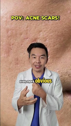How to treat acne scars