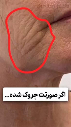 ‎محمدرضا لطفی | پوست | مشاور پوست‎ on Instagram‎: "اتو پوست بلاخره پیدا شد😍⁣⁣ ⁣⁣ #پوست⁣⁣ .⁣⁣ .⁣⁣ .⁣⁣ .⁣⁣ ⁣⁣ اين ويديو با كمك هوش مصنوعى ساخته شده | محتواى اين صفحه صرفاً⁣⁣ آموزشى است و جايكَزين مشورت پزشكى نمى باشد.⁣⁣ This video was created with the help of artificial intelligence | The information in this video may not be comprehensive, and the recovery period and results may vary for each individual. This information is not a substitute for medical advice. Consult your dermatologist For defin