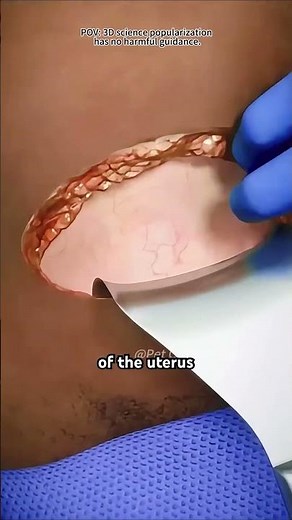 C section procedure(3D Animation)