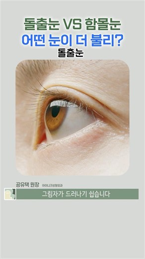 돌출눈 VS 함몰눈 어떤 눈이 더 불리?