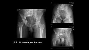 Surgical Complications of Pelvic Fractures