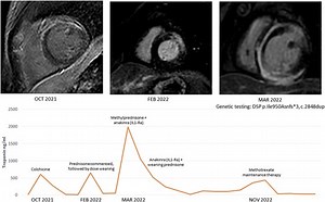 Recurrent immunosuppressive-responsive myocarditis in a patient with desmoplakin cardiomyopathy: a case report