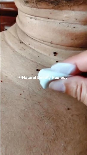 ✨ Remove warts naturally 🌿Simple tips, real results 💯#Wart #Natural #HealthTips #ytshorts