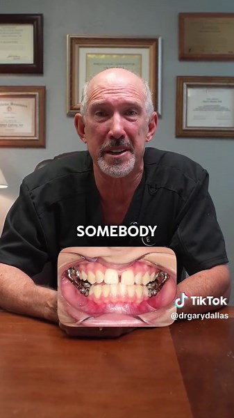 Understanding the Herbst Appliance in Orthodontics