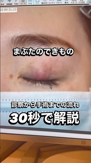 霰粒腫（さんりゅうしゅ：まぶたのできもの）の診察、手術の流れです #まぶた #眼形成 #できもの #ものもらい #霰粒腫 #粉瘤