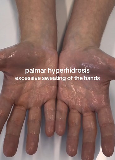 Do your hands excessively sweat? It may be a condition called