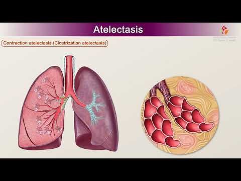 Atelectasis : Etiology, Clinical Features, Pathology, pathophysiology, Diagnosis, and Treatment
