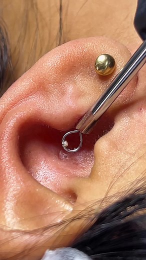 Extracción de comedon en oreja 👂 #extractions #extraccionpuntosnegros #extracciondeespinillas #puntosnegrosencara #puntonegrogigante #puntonegro #chile