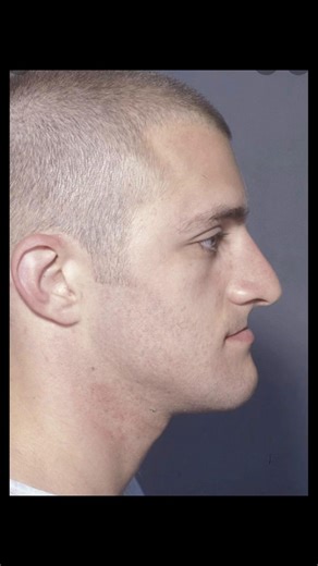 Recessed Maxilla: Understanding Its Impact on Looks