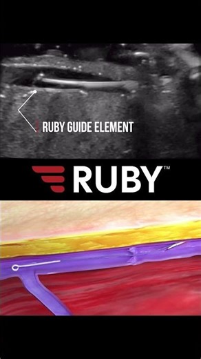 Ruby soft-tip guide element AST Peripheral IV catheter is finally here! #nurse #docto...