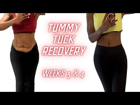 Tummy Tuck Transformation: Weeks 3- 4 Progress