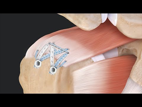 Compression SpeedBridge™ Rotator Cuff Repair